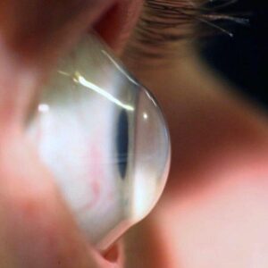 Beyond Cross-Linking: A New Way of Thinking About Keratoconus