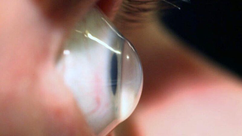 Beyond Cross-Linking: A New Way of Thinking About Keratoconus