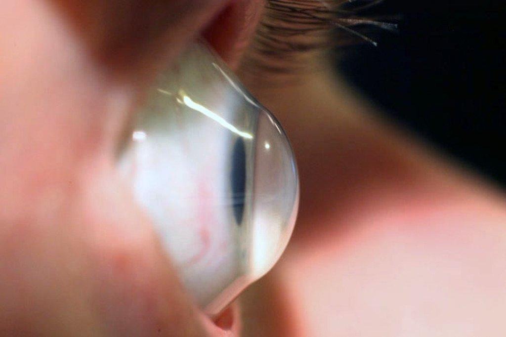 Beyond Cross-Linking: A New Way of Thinking About Keratoconus